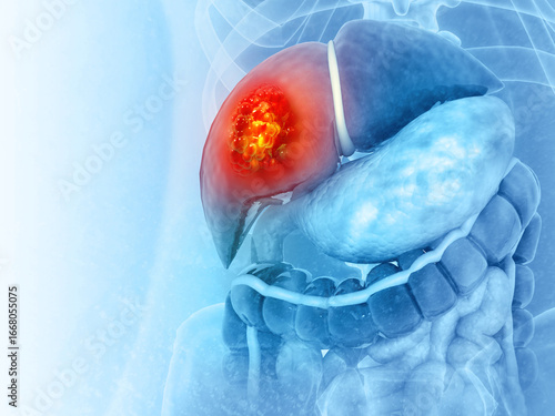 Liver cancer or liver tumor, Hepatocellular carcinoma (HCC), causes, symptoms, treatments, 3d illustration