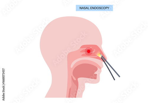 Nasal endoscopy poster