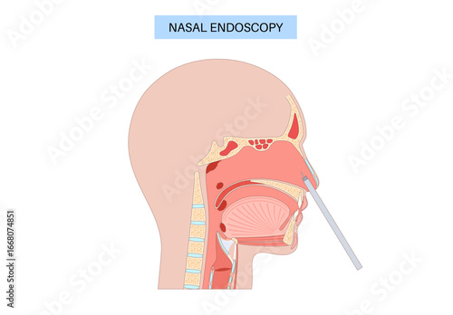 Nasal endoscopy poster