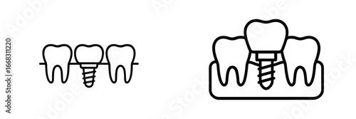 Illustration of dental implants showcasing restorative procedures