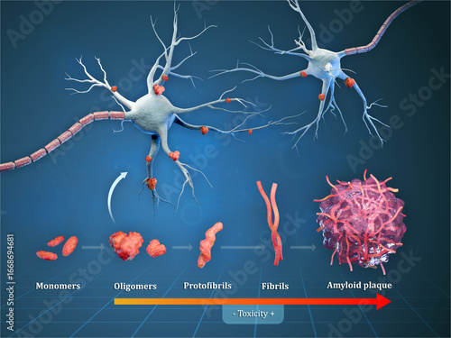 Amyloid plaques formation in Alzheimer disease