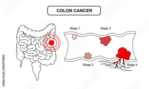 Drawing Illustration of colorectal cancer stages. Concept of colon cancer progression. Spread of tumor to lymph nodes. Medical vector line drawing for clinics, education, and science.