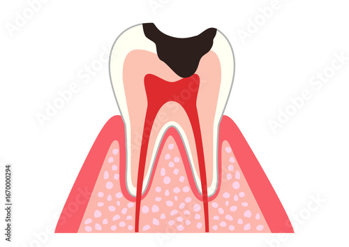 Cross-section of a tooth showing extensive decay and inflamed pulp.