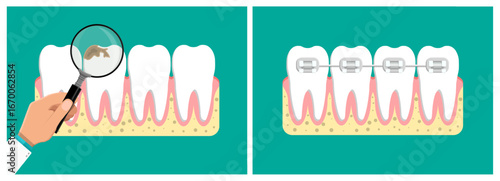 Human hand with magnifying glass examines tooth decay, and healthy teeth with braces. Dental care and orthodontics concept.