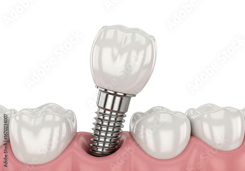 Advanced Dental Implant: 3D Render of a Tooth Restoration with Crown and Screw Post Being Placed into Gum, Illustrating Modern Dentistry and Oral Surgery