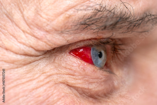 Bild auf Leinwand Bloodshot male eye detailed close-up shot, revealing raw detail burst vessel and