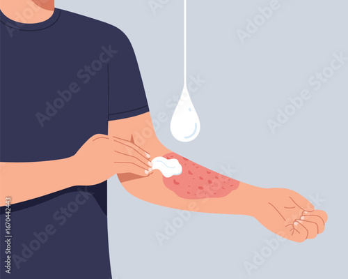 Soothing Skin Applying Cream to Treat an Irritated Arm