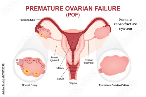Premature Ovarian Failure (POF) Flashcard Illustration