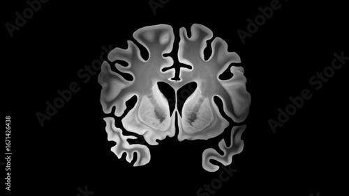 Alzheimer bilateral coronal brain slice with cortical thinning widened sulci enlarged ventricles and medial temporal lobe atrophy affecting both hemispheres