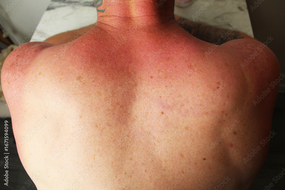 Fototapeta premium traces of sunburn. Sunburn on the skin