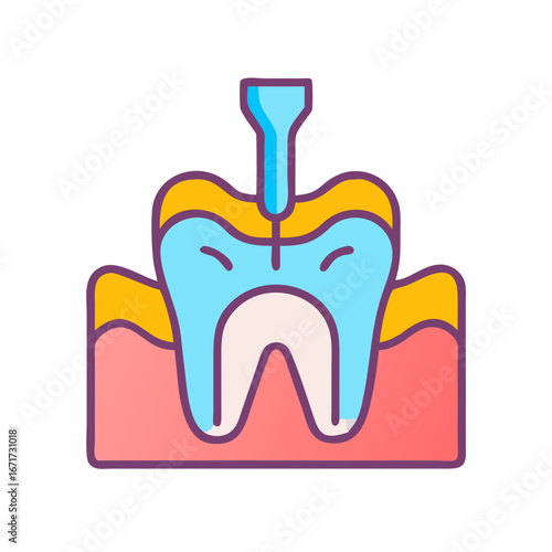 Root canal procedure visual showing tooth anatomy and pulp removal