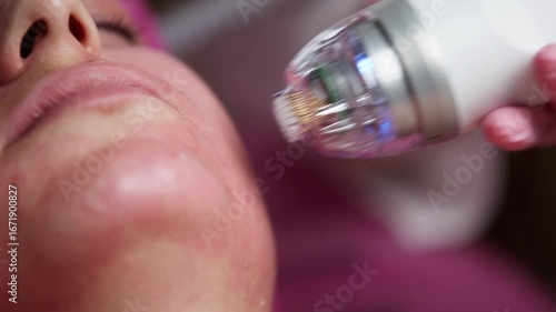 A close-up of the microneedle RF lifting procedure in a beauty salon. A young woman enjoys high-quality facial treatment, highlighting the significance of professional cosmetic procedures.