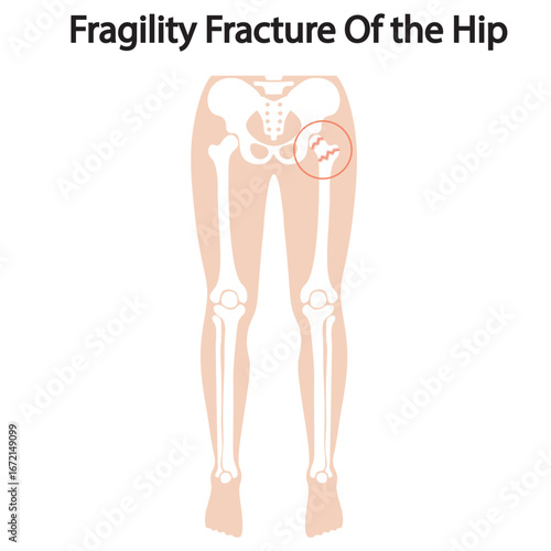Vector illustration of fragility hip fracture showing pain, immobility, swelling, bruising, plus related conditions like osteoporosis and femoral leg injury.
