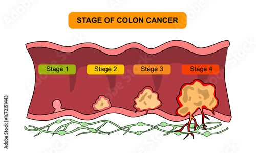 Stage of colon cancer illustration. Concept of colorectal cancer progression. Spread of tumor to lymph nodes. Medical vector illustration for clinics, education, and science.