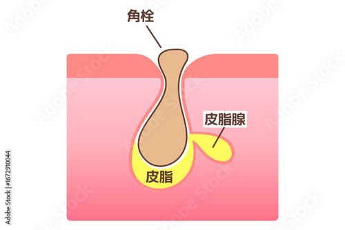 毛穴に角栓が詰まっている様子を示した図解イラスト