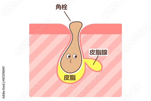 毛穴にキャラクター風の角栓が詰まっている様子を示した図解イラスト