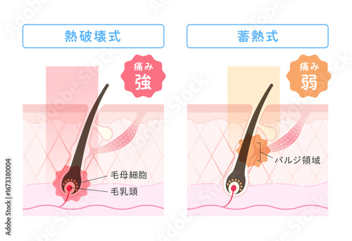 レーザー脱毛、熱破壊式・蓄熱式の比較イラスト
