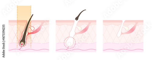 医療脱毛・レーザー脱毛のしくみ