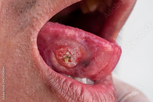 Squamous cell carcinoma of the tongue. Closeup view of oral cancer or malignant tumor.