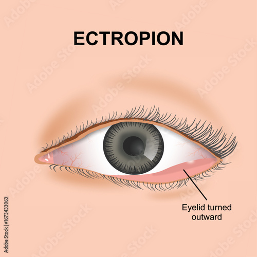 Ectropion eyelid flashcard eye illustration