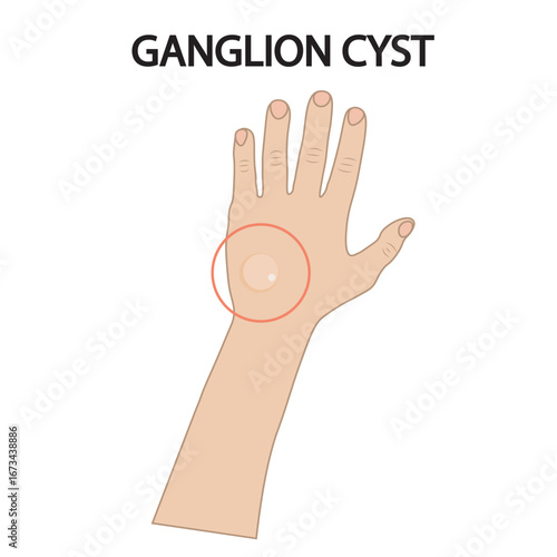 Vector illustration of ganglion cyst showing a fluid-filled lump with pain, stiffness, tingling, and weakness, alongside related conditions like lipoma and synovitis hand icon