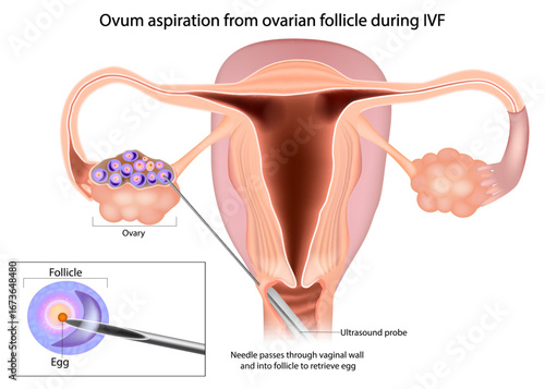 Ovum aspiration from ovarian follicle during IVF. Ultrasound-guided transvaginal aspiration of ovarian follicles to obtain oocytes