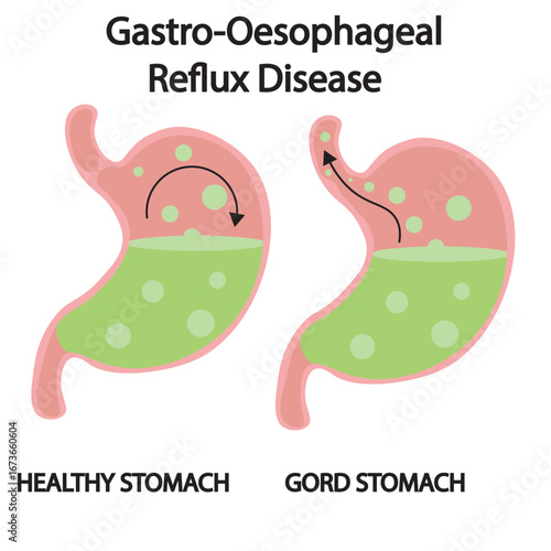 Vector illustration of gastro-oesophageal reflux disease showing heartburn, regurgitation, chest discomfort, plus related conditions like gastritis, peptic ulcer, and hiatal hernia stomach