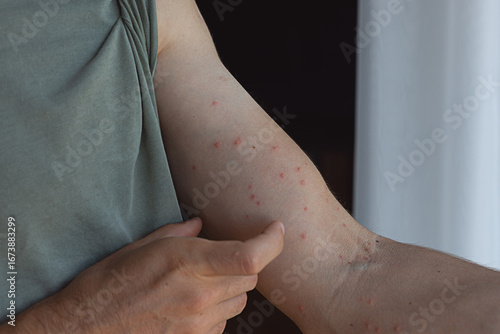 Tableau sur toile Damaged skin on male's hand