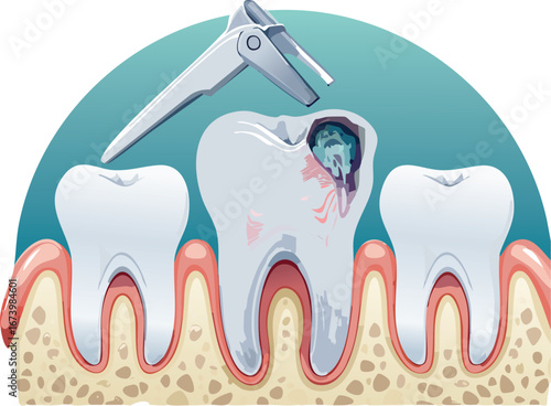 Educational vector showing dental extraction procedure to promote oral health awareness in young audiences.
