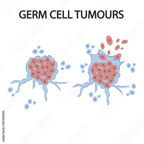 Vector illustration of germ cell tumours showing symptoms like lumps, pain, swelling, and hormonal changes, with related conditions such as seminoma, teratoma, and ovarian tumours.icon