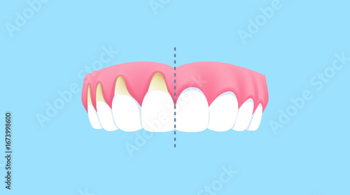 Upper teeth - Recession gums (Before and After Comparison) illustration vector design. Dental care concept.