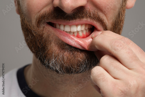 Man showing inflamed gum on grey background, closeup