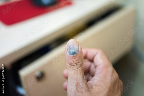 Human thumb finger is hurt by drawer pinched, cause blood blister inthe nail. Unsafe or hazard at workplace, close-up with selective focus.