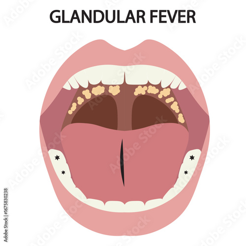 Vector illustration of glandular fever showing fatigue, sore throat, fever, swollen lymph nodes, with similar illnesses like tonsillitis, flu, and viral pharyngitis mouth icon