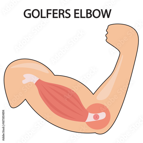 Vector illustration of golfer’s elbow showing inner elbow pain, stiffness, weakness, tingling, and related conditions like tendonitis and nerve entrapment silhouette