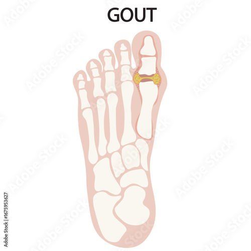 Vector illustration of gout showing joint inflammation, redness, swelling, and severe pain, with related conditions such as arthritis, pseudogout, and rheumatoid disorders leg skeleton
