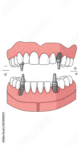 Understanding dental implants how they work and what to expect during the procedure