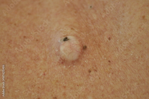 A protruding ulcer on a man's back.Highly Infected Sebaceous Cyst on Senior Man's Back