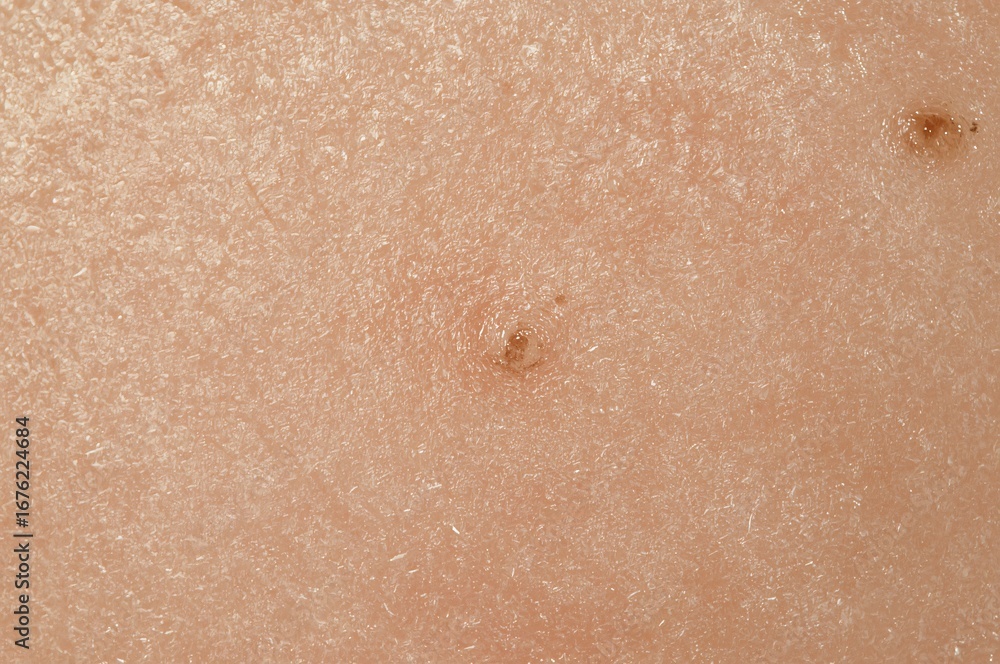 Fototapeta premium Close-up skin texture; moles; medical; background blur; dermatology