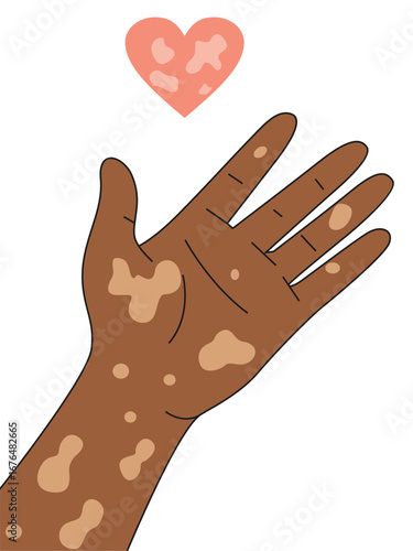 Hand vitiligo people with love. Unique skin pigmentation highlighting natural beauty. World vitiligo day. Skin depigmentation, skin disorder, self acceptance, emotional support.	