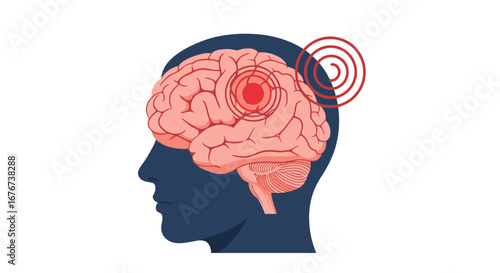 Illustration of Human Brain with Pain Points Indicating Headache, Migraine, or Neurological Disorder