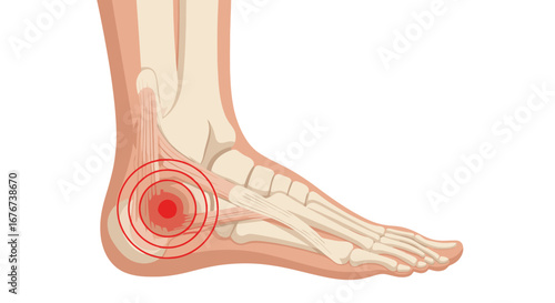 Medical Illustration Depicting Human Foot Anatomy with Concentrated Pain in the Achilles Tendon and Heel Area