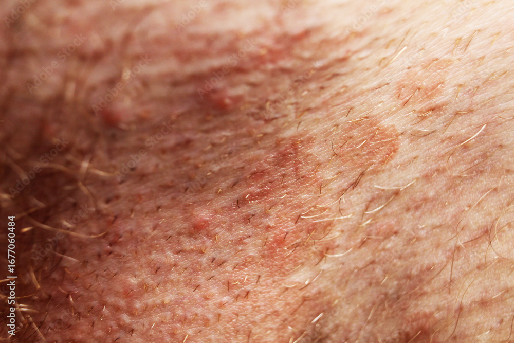 Fototapeta premium dark spots on the skin, swelling. Skin diseases