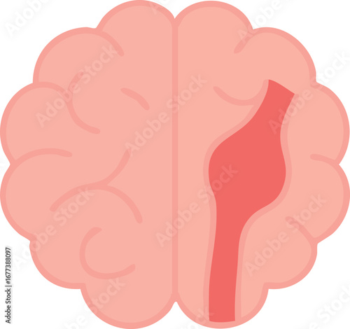 This is a flat vector illustration of a human brain with a highlighted red bulging blood vessel on the right side, representing a brain aneurysm.