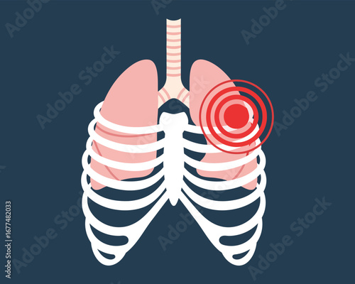 Illustration of human lungs within a rib cage with a pain indicator on the right lung