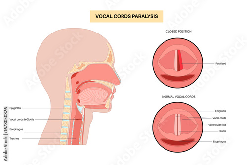 Vocal cords paralysis