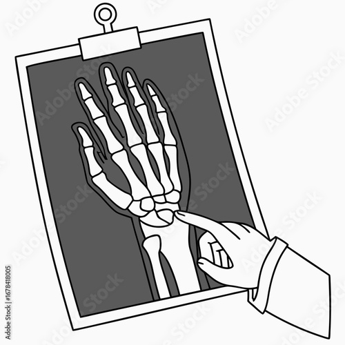 Doctor s hand pointing at a medical x ray of a human hand and wrist bones on a clipboard