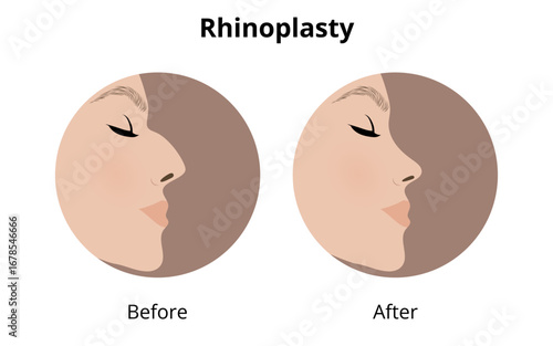 Woman's profile showing rhinoplasty results, before and after