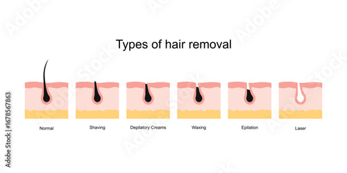 Different types of hair removal: shaving, waxing, depilatory cream, epilator, laser.  Suitable for beauty, skincare, tutorial, comparison, or infographic use. 
