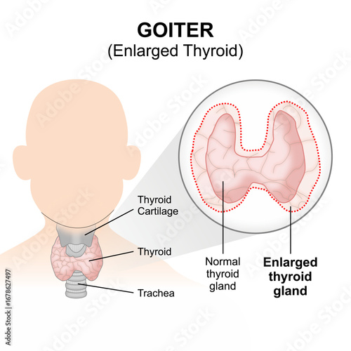 Goiter - Enlarged thyroid, flashcard illustration
